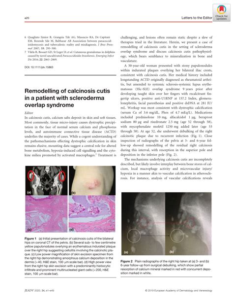 (PDF) Remodeling of calcinosis cutis in a patient with scleroderma overlap syndrome