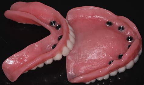 Glidewell Inclusive Mini Dental Implant Dentures | Denture implants, Dental implants cost, Tooth ...
