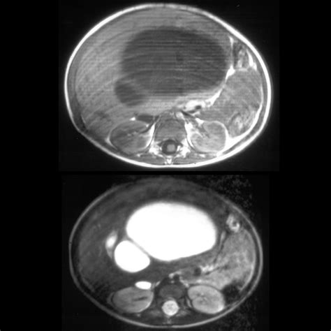 Pediatric Mesenchymal Hamartoma | Pediatric Radiology Reference Article | Pediatric Imaging ...