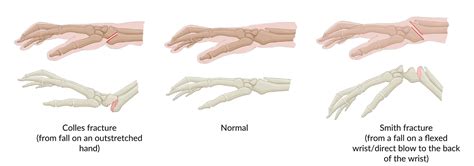 Smith Fracture