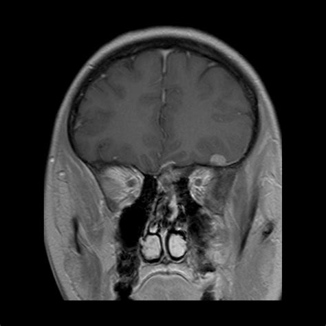 Neurofibromatosis Type 2 Mri