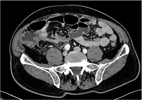 Abdominal CT scan showing acute appendicitis. | Download Scientific Diagram