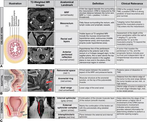 Types Of Rectal Tumors