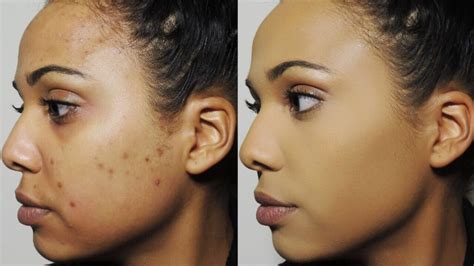 Get Rid of Dark Spots on Face – Causes, Best Creams, Home Remedies & Treatments for Facial Black ...