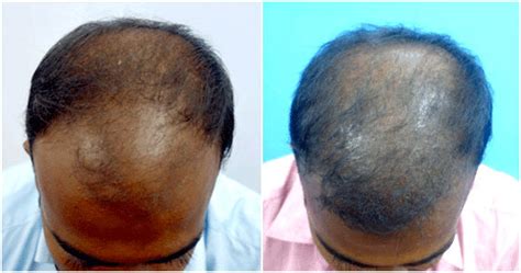 PRP Hair Treatment in India: Cost, Side Effects & Success Rate ...