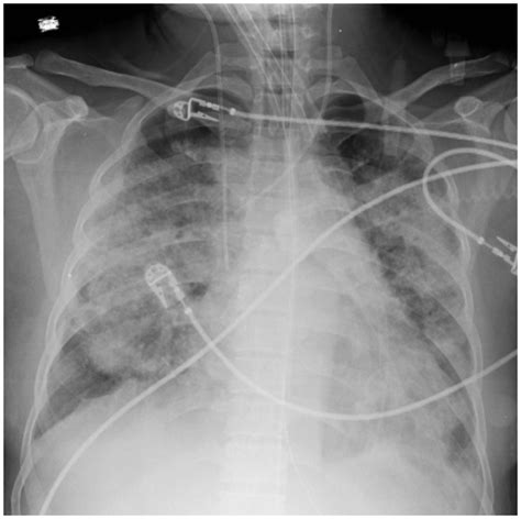 Chest x-ray representing acute lung injury. | Download Scientific Diagram