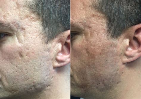 Acne Scars - Minuk Laser Centre - Winnipeg Manitoba Canada