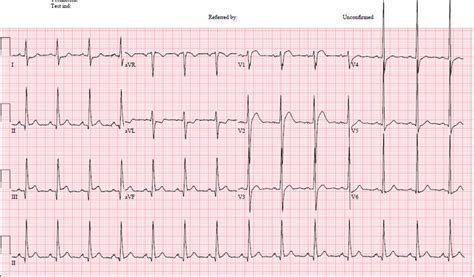 12 Lead Ecg With St Elevation