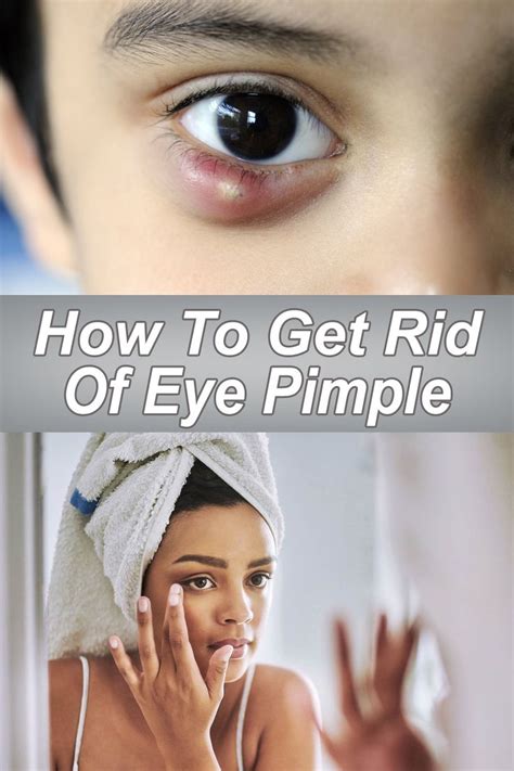 How To Get Rid Of Eye Pimple | Pimples, Common eye problems, How to get rid