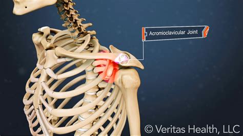 A Visual Guide to Shoulder (AC Joint) Arthritis | Arthritis, Joint ...