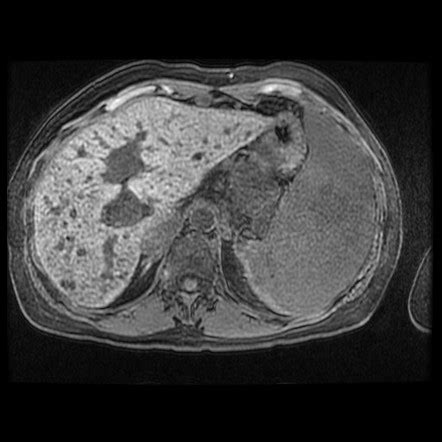 Caroli disease | Image | Radiopaedia.org