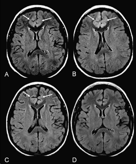 Lobes Of Brain Axial