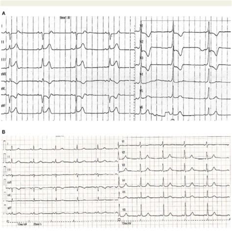 The Levine sign of acute myocardial ischemia. The clenched fist... | Download Scientific Diagram