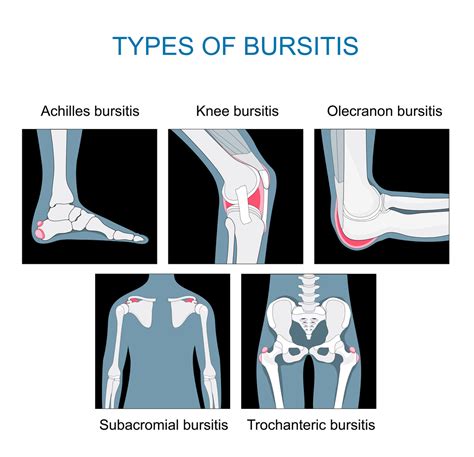 Infected Olecranon Bursitis