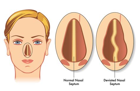 Deviated Septum: Symptoms and Treatments - University Health News