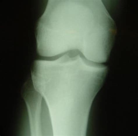 Three Different Types of Knee X-Rays With Photos | HealDove