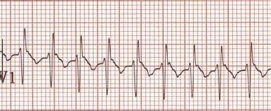 Paediatric ECG Interpretation • LITFL • ECG Library Basics