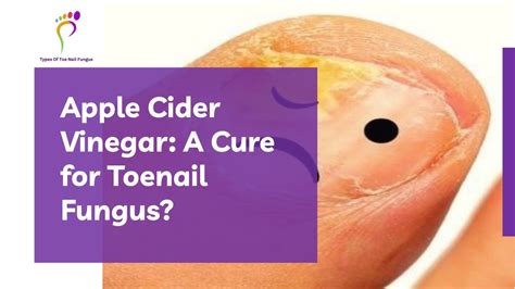 PPT - Apple Cider Vinegar For Toenail Fungus PowerPoint Presentation ...