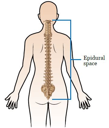 Tingling After Epidural Injection - mapametawan