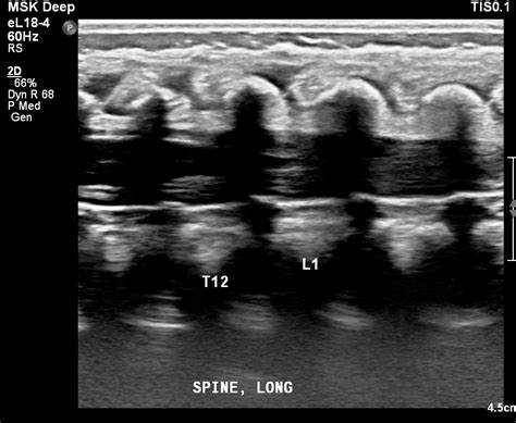 Neonatal Ultrasound Lumbosacral spine | Radiology Template Reports