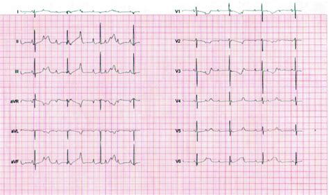 Complete congenital foetal heart block: a case report. - Abstract ...