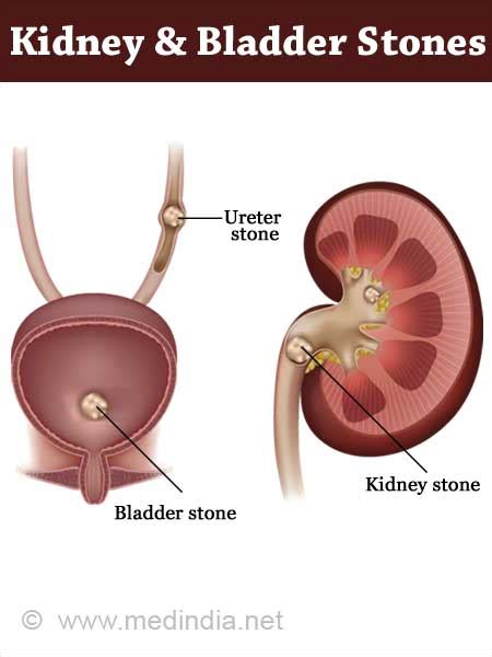 Renal Calculi Icd 10