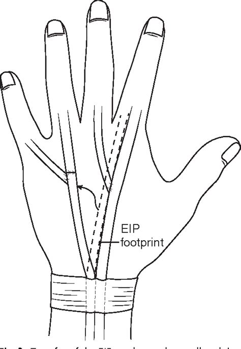 Figure 3 from Tendon Transfers in the Rheumatoid Hand for Reconstruction. - Semantic Scholar