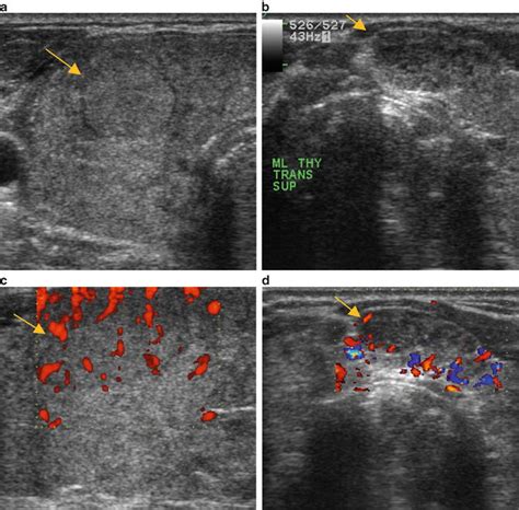 Pattern Recognition of Benign and Malignant Thyroid Nodules: Ultrasound Characteristics and ...