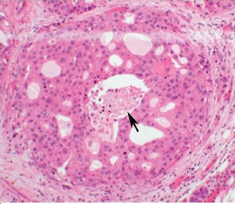 The histologic section of the parotid gland tumor shows a malignant ...