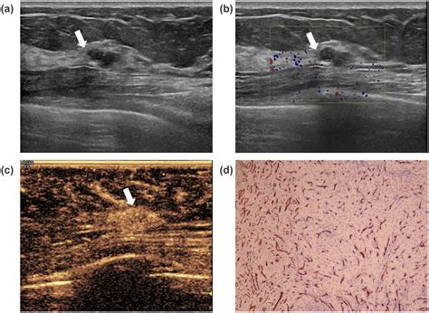 Contrast-enhanced ultrasound features of breast capillary hemangioma: a ...