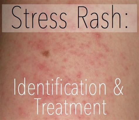 Stress Rash: Causes, Symptoms, Pictures, & Treatment | HubPages