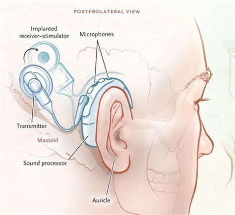 Cochlear Implants Surgery in New Delhi | ID: 26431573548