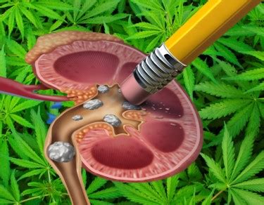 Got Stones? - Cannabis Can Lower the Risk of Kidney Stones in Men Says New Medical Study