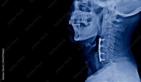 Lateral projection cervical spine x-ray showing anterior cervical discectomy and fusion or ACDF ...