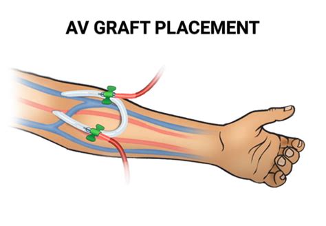 Dialysis Fistula Vs Graft