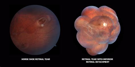 Retinal Tear: Symptoms, Causes, and Treatment