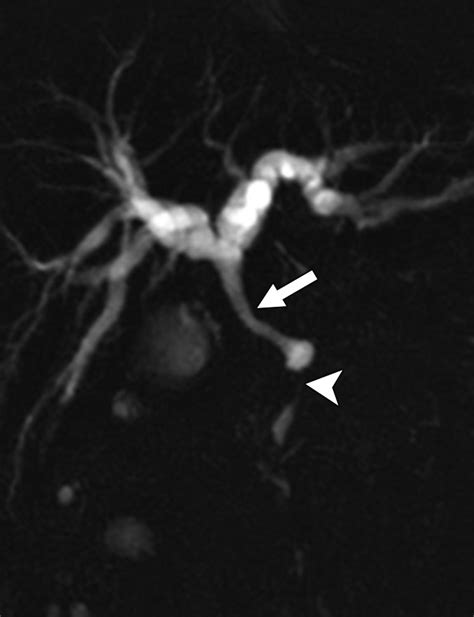 IgG4-Related Sclerosing Cholangitis: A Clinical and Imaging Review | AJR