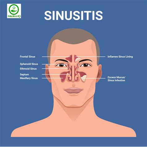 Sinusitis Causes, Symptoms & Treatment ( Sinus Infection )