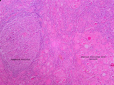 Hashimotos thyroiditis – Histopathology.guru