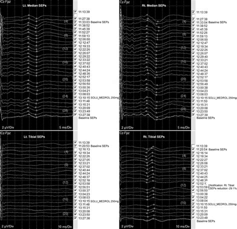 Neurophysiological monitoring of somatosensory evoked potentials ...