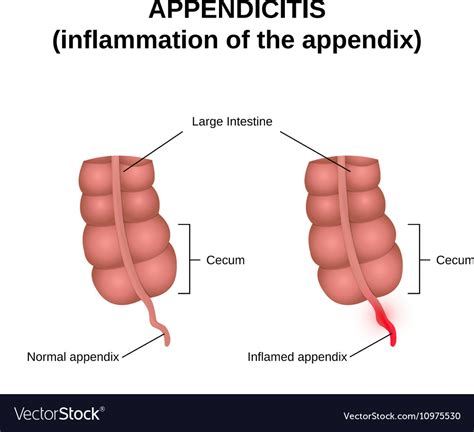 Inflammation Of The Appendix Appendicitis Vector Image | The Best Porn Website