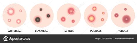 Types Acne Illustration Whitehead Blackhead Papules Pustules Nodules ...