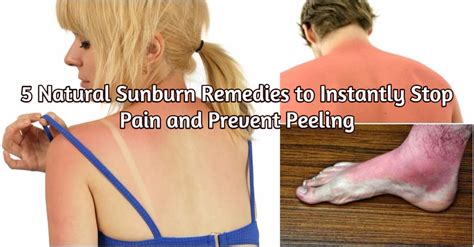 5 Natural Sunburn Remedies to Instantly Stop Pain and Prevent Peeling - DIY & Crafts