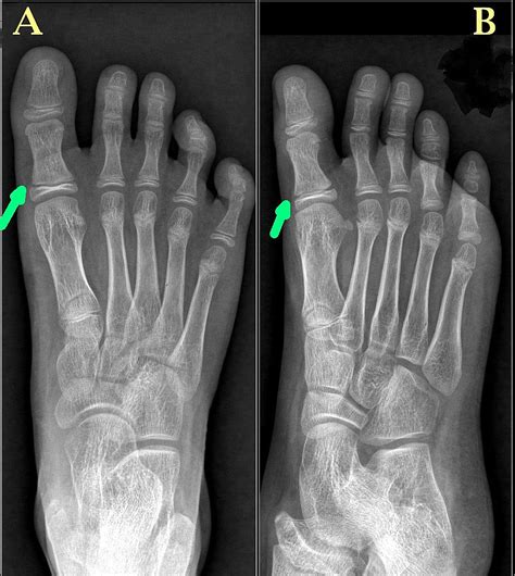 Great Toe Proximal Phalanx Fracture