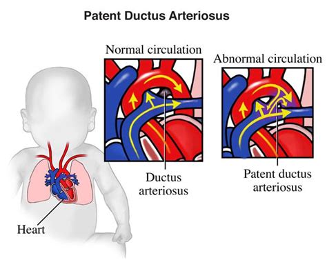 Patent Ductus Arteriosus Nursing Care Plan