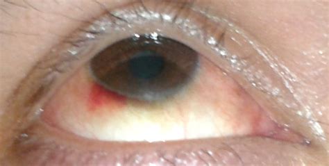 What Causes Broken or Burst Blood Vessels in the Eyes? | HealDove