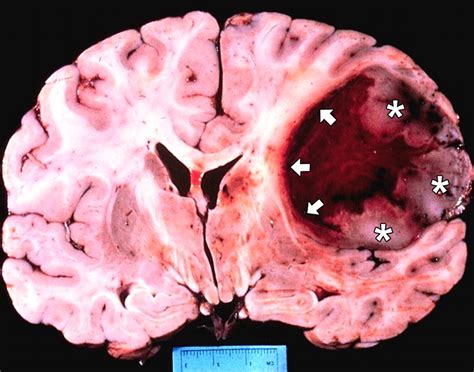 Glioblastoma and Brain Cancer | Neuro News & Cosmo Clues