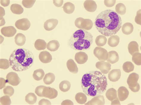 Syndrome, myelodysplastic. Causes, symptoms, treatment Syndrome ...