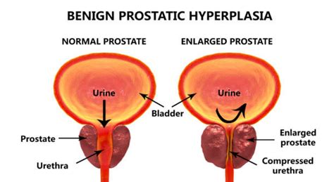 Benign Prostatic Hyperplasia: Causes, Risk Factors and Treatment - Dr. Suraj Lunavat