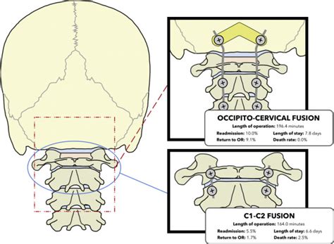 C1-C2 Fusion - Dr. Nikhil Malewar